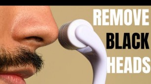 'How to Professionally Remove Blackheads At Home | Use THESE Tricks'